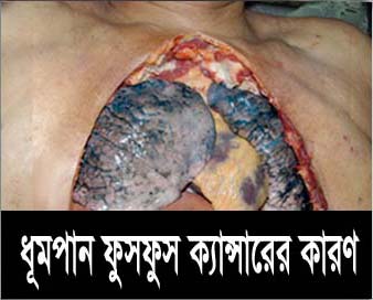 Bangladesh Health Effects Lung - lung cancer, diseased organ (Bengali)